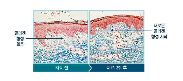 트리플물광젯