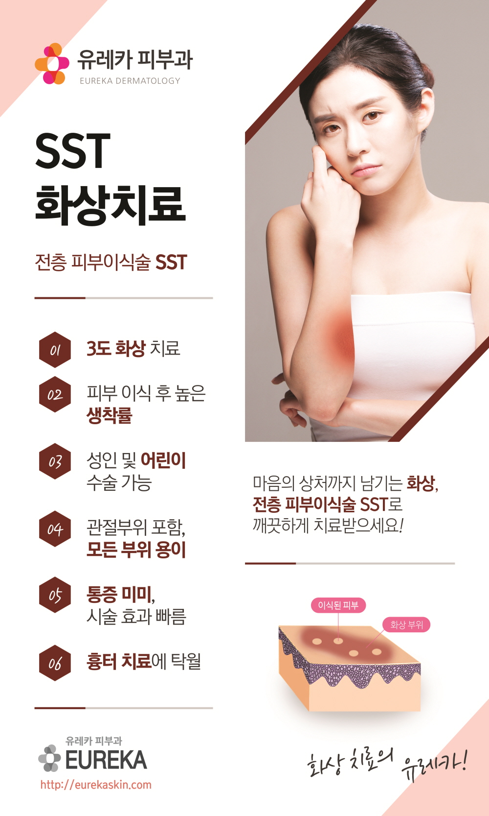 SST화상치료.jpg